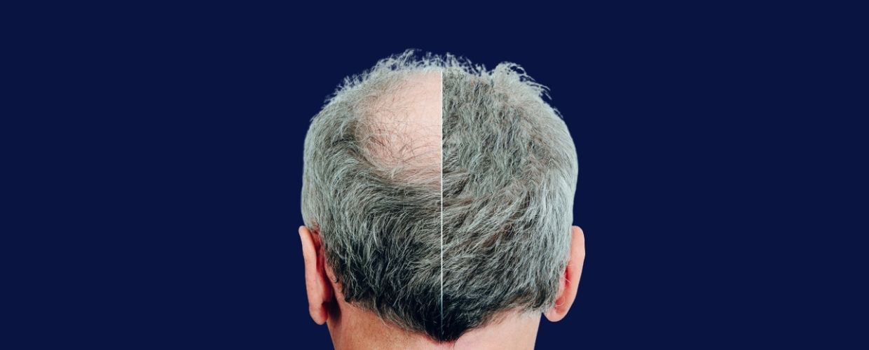 What Causes Hair Loss? - Stagger