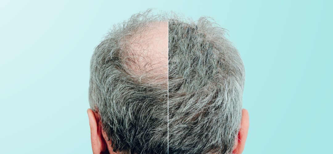 can-hair-grow-back-from-baldness