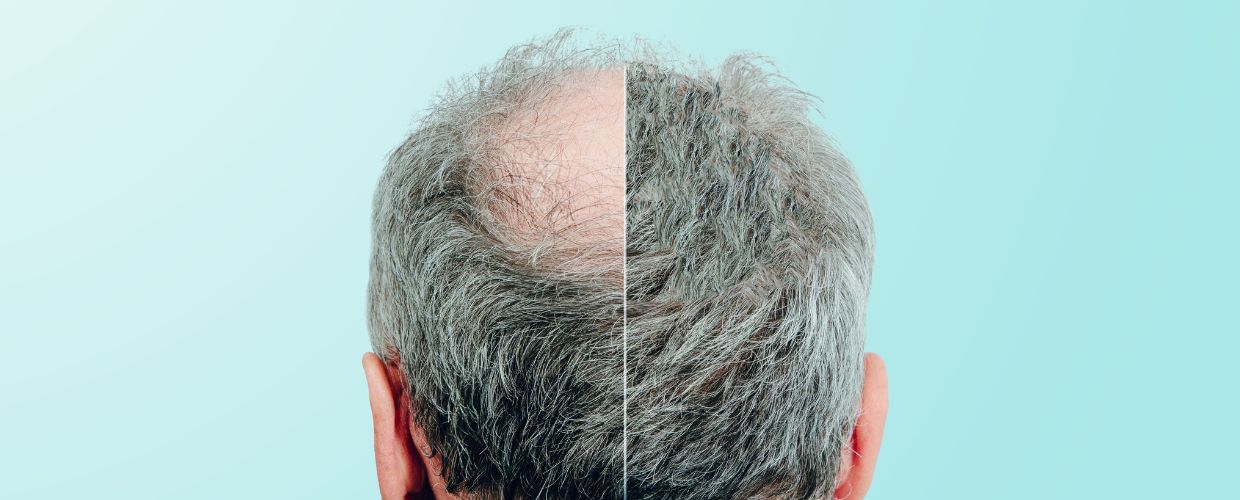 can-hair-grow-back-from-baldness