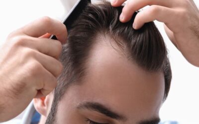 Effective Receding Hairline Treatment