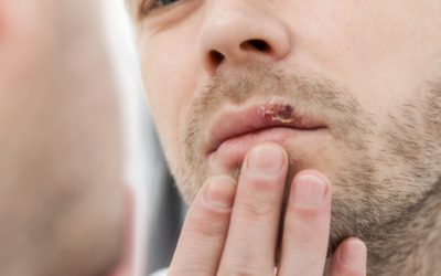 What Causes Cold Sores?